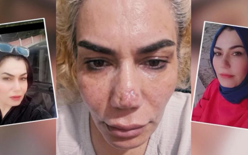 Estetik Ameliyatı Sonucunda Burun Görümünde Değişiklikler ve Hasta Şikayetleri